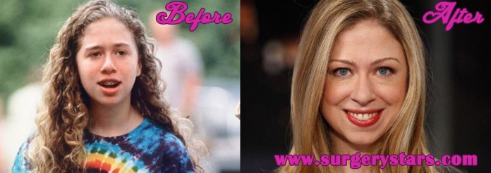 Chelsea Clinton Plastic Surgery