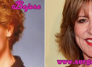 Christine Lahti Plastic Surgery