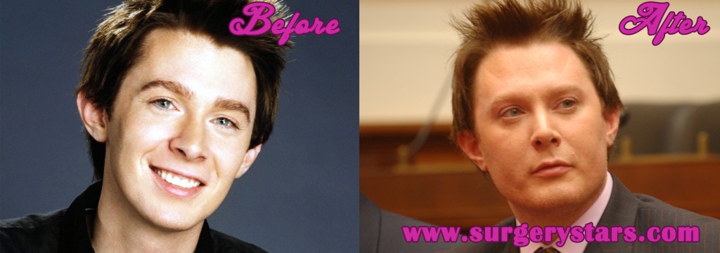  clay aiken plastic surgery