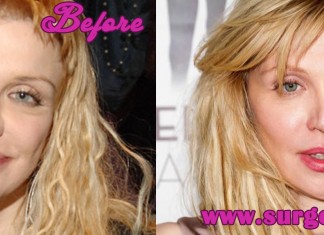 Courtney Love Plastic Surgery