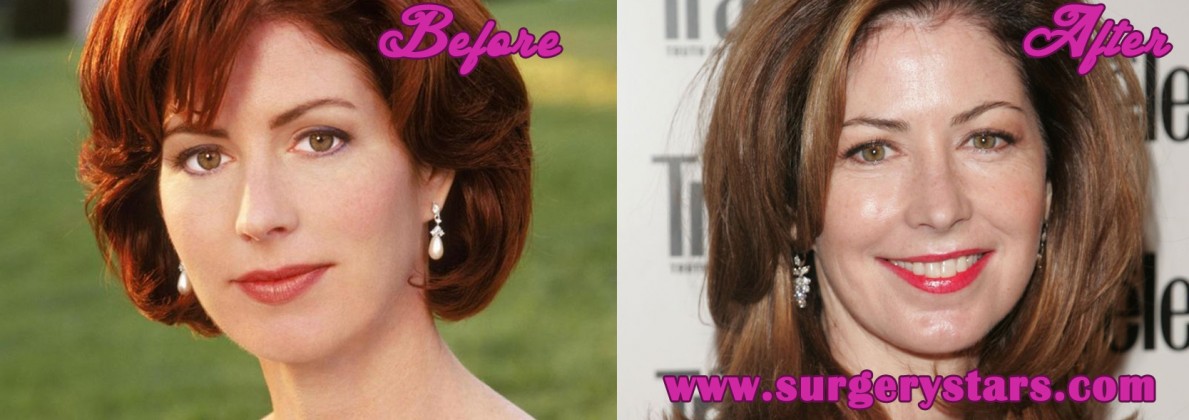 Dana Delany Plastic Surgery Before and After Pictures