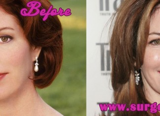 Dana Delany Plastic Surgery