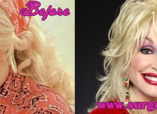 Dolly Parton Plastic Surgery