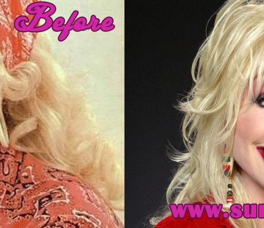 Dolly Parton Plastic Surgery
