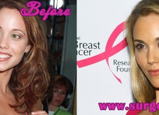 Elizabeth Berkley Plastic Surgery