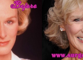 Glenn Close Plastic Surgery