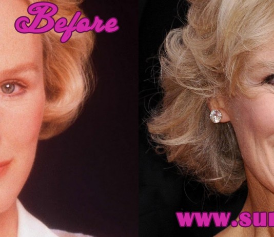 Glenn Close Plastic Surgery