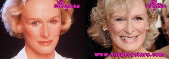 Glenn Close Plastic Surgery