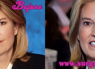 Greta Van Susteren Plastic Surgery