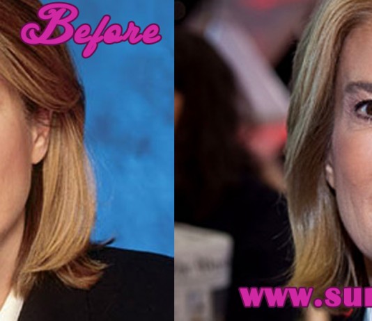 Greta Van Susteren Plastic Surgery