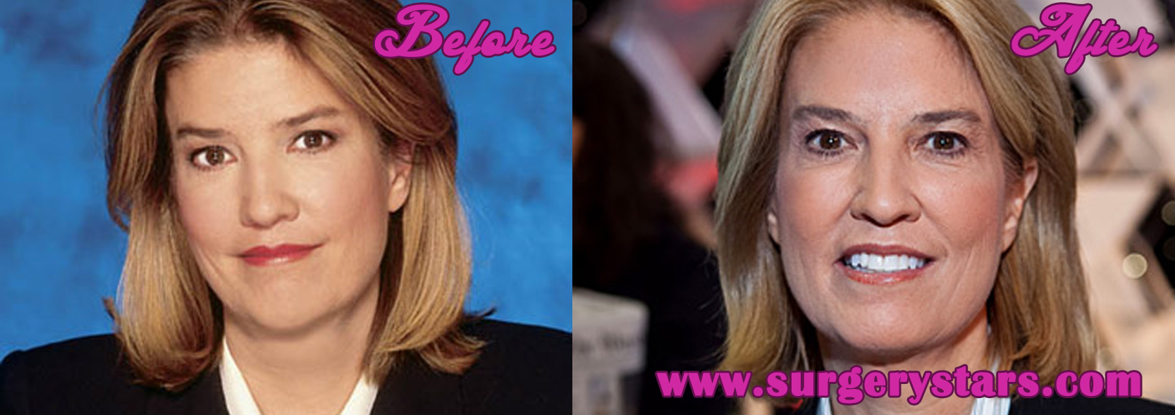 Greta Van Susteren Plastic Surgery - Before and After Pictures.