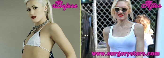 Gwen Stefani Plastic Surgery