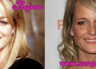 Helen Hunt Plastic Surgery