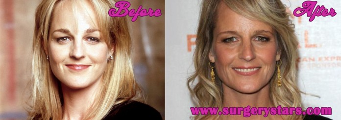 Helen Hunt Plastic Surgery