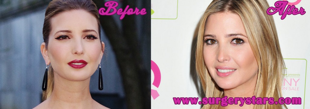 Ivanka Trump Plastic Surgery