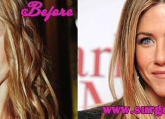 Jennifer Aniston Plastic Surgery