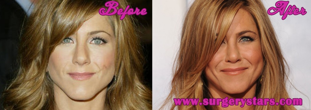 Jennifer Aniston Nose Job Before & After Pictures