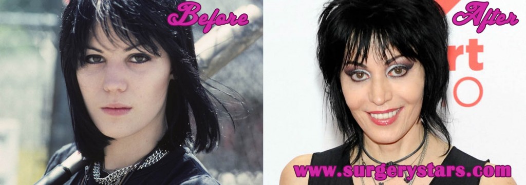 Joan Jett Plastic Surgery