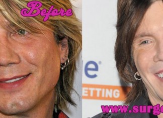 John Rzeznik Plastic Surgery