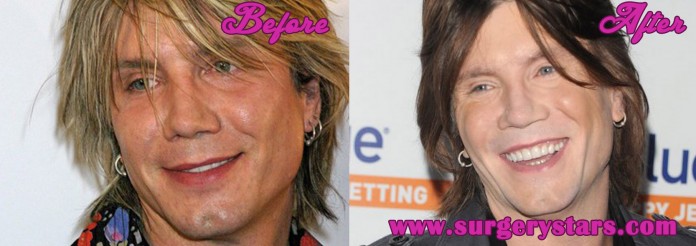 John Rzeznik Plastic Surgery