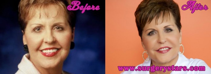 Joyce Meyer Plastic Surgery