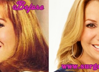 Kathie Lee Gifford Plastic Surgery