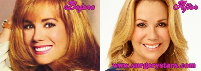 Kathie Lee Gifford Plastic Surgery