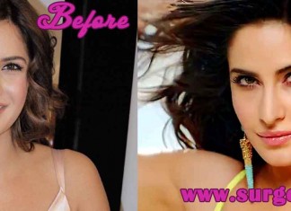 Katrina Kaif Plastic Surgery