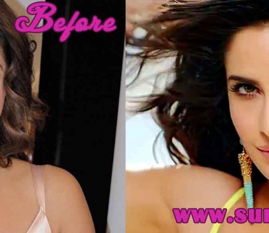 Katrina Kaif Plastic Surgery