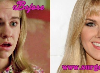 Laura Bell Bundy Nose Job