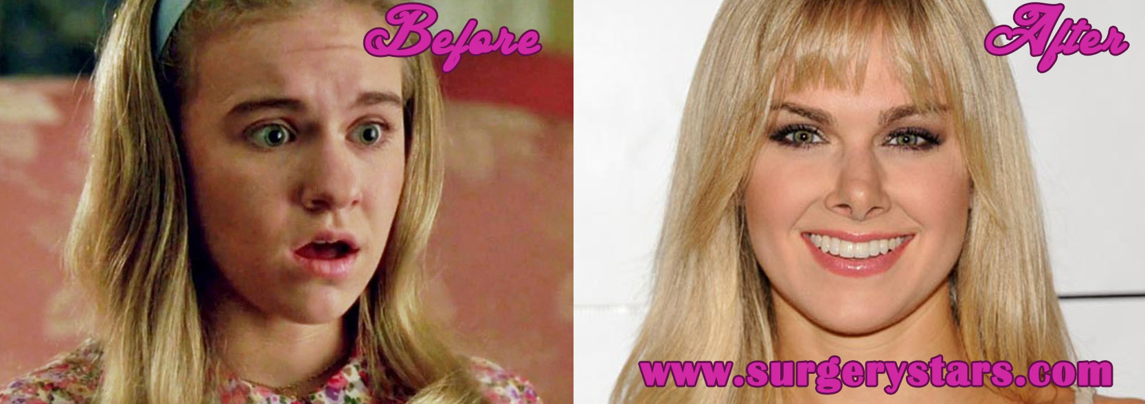 Laura Bell Bundy Nose Job - Before and After Pictures.