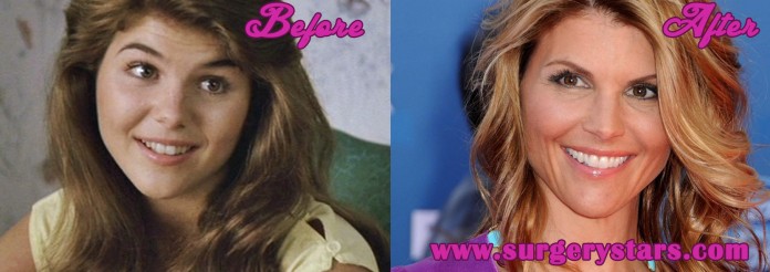 Lori Loughlin Plastic Surgery