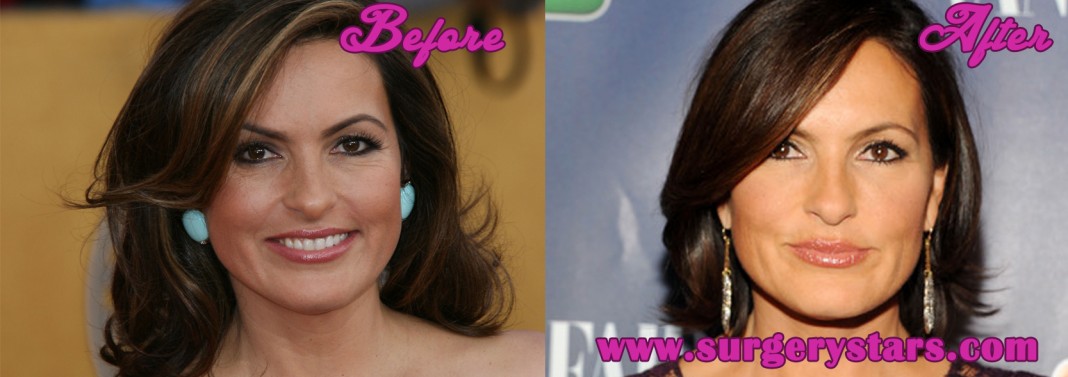 Mariska Hargitay Plastic Surgery Pictures