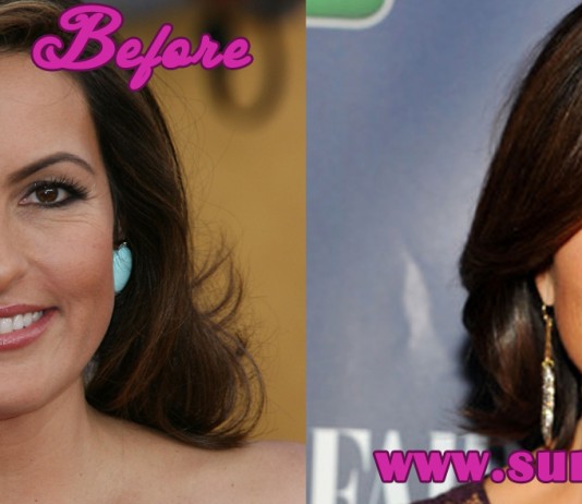 Mariska Hargitay Plastic Surgery