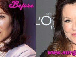 Mary Mcdonnell Plastic Surgery