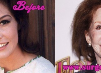 Mary Tyler Moore Plastic Surgery