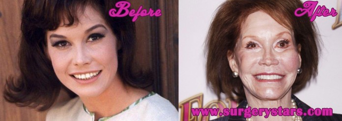 Mary Tyler Moore Plastic Surgery