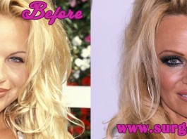 Pamela Anderson Plastic Surgery