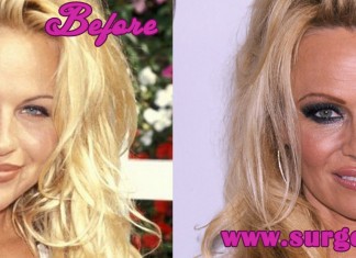 Pamela Anderson Plastic Surgery