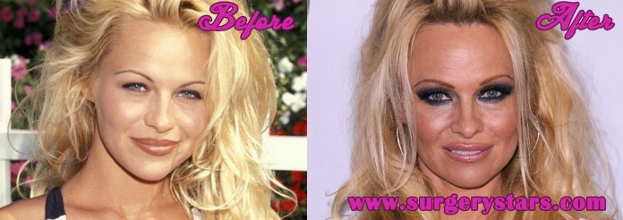 Pamela Anderson Plastic Surgery