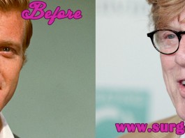 Robert Redford Plastic Surgery