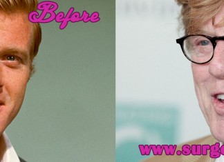 Robert Redford Plastic Surgery