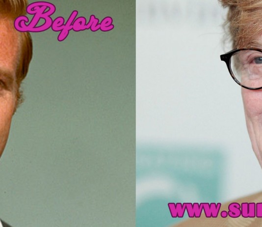 Robert Redford Plastic Surgery