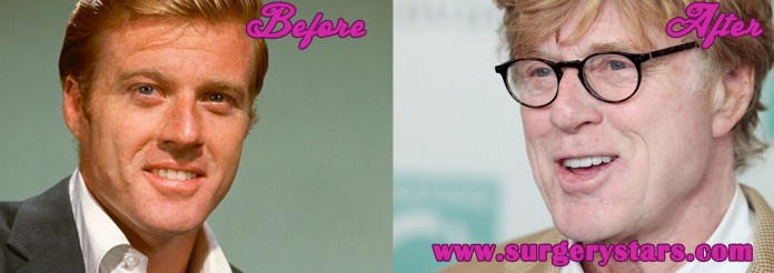 Robert Redford Plastic Surgery