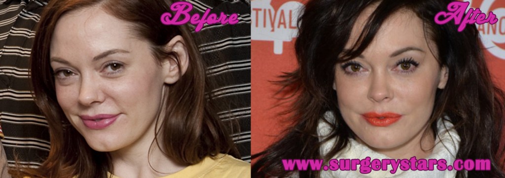 Rose McGowan Plastic Surgery