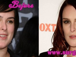 Rumer Willis Plastic Surgery