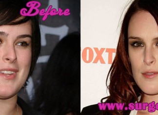 Rumer Willis Plastic Surgery