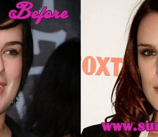 Rumer Willis Plastic Surgery