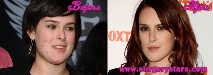 Rumer Willis Plastic Surgery