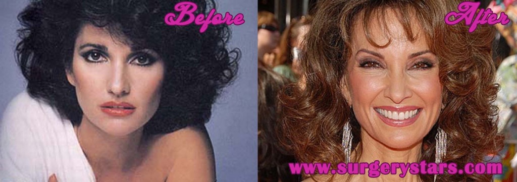 Susan Lucci Plastic Surgery